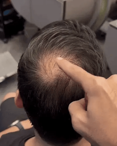 Hair Density Filler